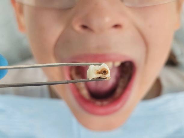 Best Cracked Tooth Emergency Dentist  in Lake San Marcos, CA